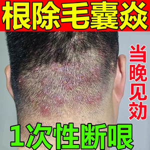 马拉色菌毛囊炎