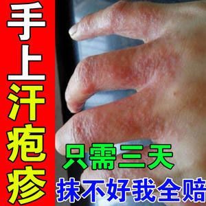 汗疱疹手痒脱皮汗孢疹汗状孢疹专用治疗手足癣手脚上起小水泡药膏