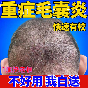治疗头皮毛囊炎专用前胸后背私处头部脖子马拉色菌痘痘中药酊膏药