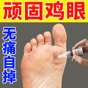 鸡眼膏贴鸡眼药水去除肉刺老茧刺瘊脚垫足部脚趾去根走路疼下地疼