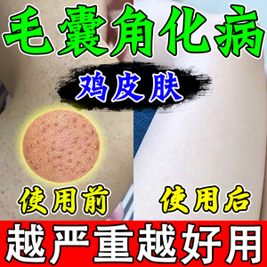 去鸡皮疙瘩毛囊角质药膏身上去鸡皮肤疙瘩毛囊角化手臂毛周角化症