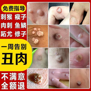 粒疙瘩去除膏刺瘊子丝状疣去除神器颈部刺猴去除正品tb857044200995