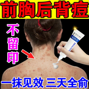 背上长痘痘后背药膏除螨虫人用祛前胸背上毛囊炎粉刺痘印淡化消印