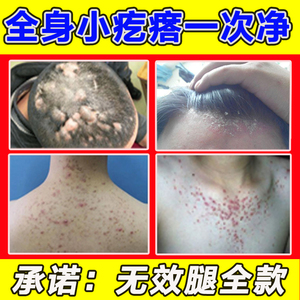 毛囊炎专用膏药头部痒治疗前胸后背马拉色菌痘痘神器脂溢皮囊炎膏