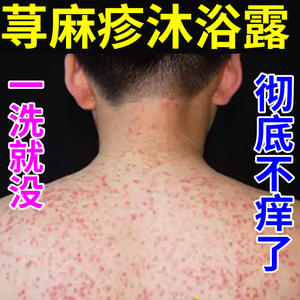 沐浴露过敏