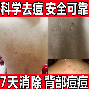 后背祛痘印膏