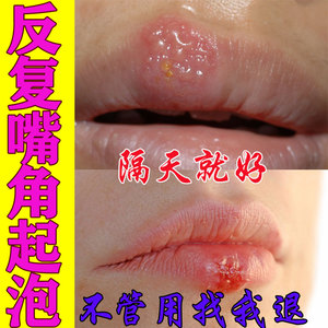 003人付款天猫日本资生堂药用润唇膏男女修复口角唇炎专用滋润保湿