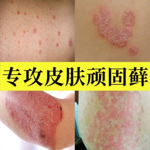洁肤王刘药师正品真菌清霜皮肤外用瘙痒止痒抑菌乳膏私处软膏1人付款