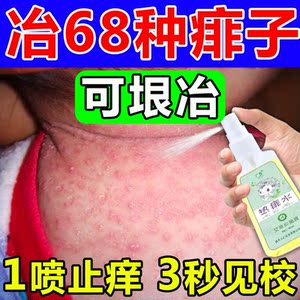 宝宝热痱水红疹脓包婴儿童成人男士去痱止痒喷雾痱子粉膏泡澡药水