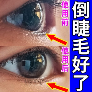 倒睫毛矫正贴儿童宝宝低敏超薄上眼皮下垂提拉下睫毛夹睑眼贴神器