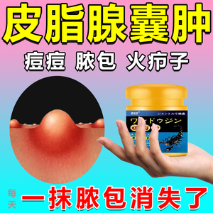 皮脂腺囊肿粉瘤去皮下脓包结节性痤疮痘痘堵塞祛除火疖子拔毒药膏