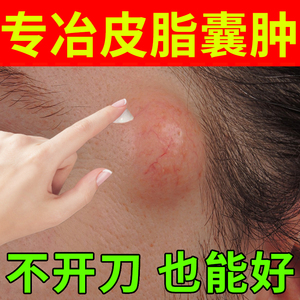 粉瘤皮脂腺囊肿膏火疖子拔毒拔脓膏神器分泌旺盛药腘窝囊肿脂肪瘤