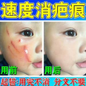 指甲抓伤疤痕灵增生修复膏疙瘩霜手术凸起儿童脸部淡化去除黑色素