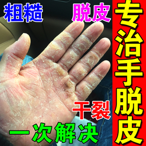治疗手脱皮的药膏手指上起皮干燥脚粗糙掉皮足底真菌感染皮肤裂开
