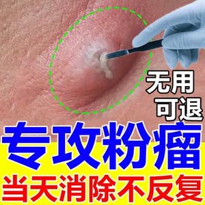 皮脂腺囊肿粉瘤皮下拔毒去除膏贴去结节性痤疮火疖子痘痘专用药膏