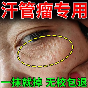 汗管瘤眼部去除神器眼部祛眼周脂肪粒扁平疣消除眼霜专用药膏日本