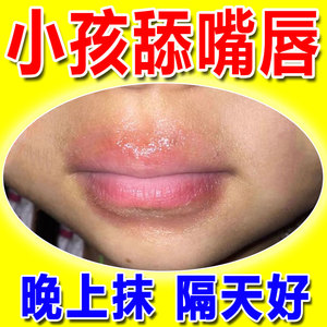 唇炎唇膏嘴唇干裂脱皮口角炎唇炎烂嘴角儿童上火疱疹流脓专用药膏