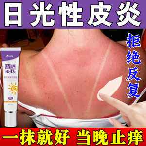 日光性皮炎太阳晒伤紫外线过敏专用药膏儿童晒后脸部皮肤发痒修复