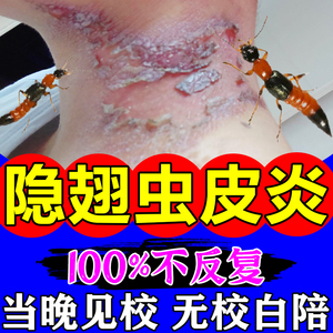 隐翅虫药膏治皮炎臭虫红火蚂蚁叮咬伤水疱糜烂瘙痒止痒消肿特效药