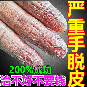 手脱皮严重脱皮专用真菌蜕皮干燥开裂手指上起皮缺维生素专用药膏