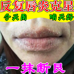 唇炎专用药膏日本治嘴唇干裂脱皮嘴角开裂起水泡去角质去死皮克星
