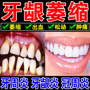 牙龈萎缩修复再生特效药牙周炎治疗药专用固齿牙疼牙齿松动药牙膏