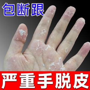 手上起皮干燥蜕皮专用治疗严重手指手掌脚底脱皮真菌感染反复蜕皮