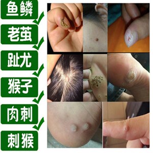 治去刺猴子的专用药急眼膏手脚上长肉刺猴子去除手足部趾疣鸡