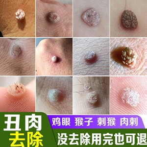 瘊子跖疣专用药刺猴去除正品肉刺断根神器去猴子肉粒疙瘩药鸡尤净