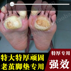 治老茧脚垫专