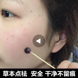 祛痣点痣膏无痕正品药水修复液笔神器美容院专用除痣取痣去痣脸部