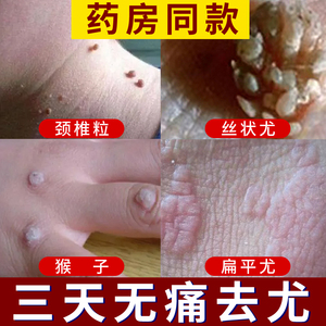 跖疣去根干扰素凝胶寻常疣专用药膏去除瘊子水杨酸手部足部跖疣净
