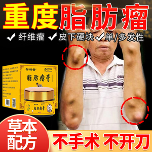 皮下脂肪瘤去除膏