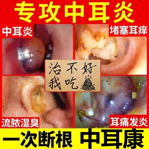 流脓水滴耳液人用烂耳朵止痒专用药治发炎耳膜穿孔可除根28人付款77