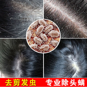 专业去剪发虫卷发虫洗发水儿童去屑止痒除螨虫吃发虫洗发露女孩正