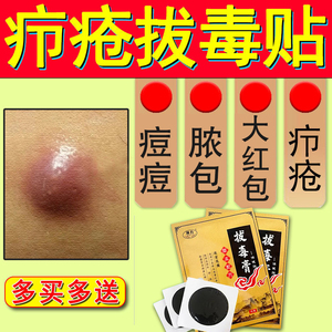 火疖子拔毒拔脓膏贴 买二送一 囊肿硬疙瘩屁股大脓包坐扳疮吸脓贴