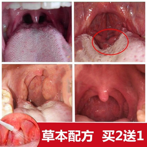 咽喉肿痛喉咙干痒异物感咳嗽扁桃体发炎肥大肿大成人儿童咽喉喷剂