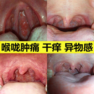 咽炎滤泡增生