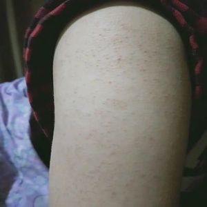 鸡皮肤疙瘩毛囊角化去除精华霜皮肤干燥起皮腿部手臂全身体乳膏药