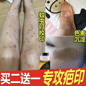 去嘴角黑色素沉淀脸部