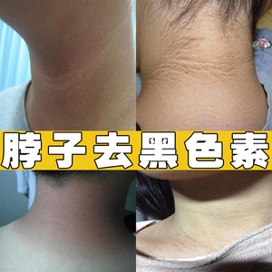 脖子美白去黑色素颈部