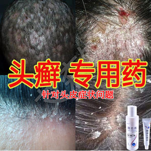 头皮屑头癣洗发水的药膏真菌感染银屑病头部藓治疗毛囊炎脓包疮膏