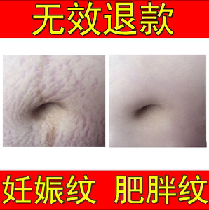 祛去除肥胖纹修复霜学生孕妇专用生长纹大腿消除妊娠纹橘皮腿部
