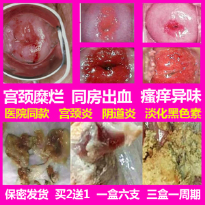 妇科炎症凝胶治疗宫颈糜烂重中度肥大囊肿霉菌性阴道炎盆腔炎用药