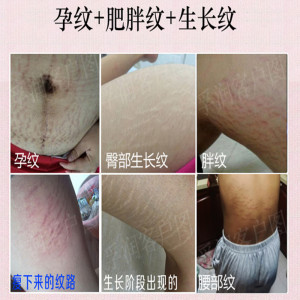 去肥胖纹学生
