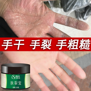 手脱皮的药修复霜