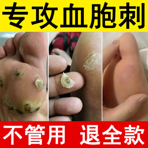 止尤净专用血胞刺跖疣膏鸦胆子抗菌剂疣足部去除血泡刺鸡眼老茧贴
