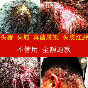 去屑止痒头廯头皮癣专用药头皮屑癣头藓抑菌杀菌抗真菌感染洗发水