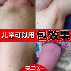 传染性软疣儿童病毒性去软疣膏大人瘊子去除药膏工具治疗水猴子药