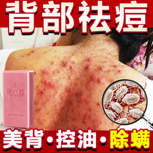 背上痘痘祛痘去印后背